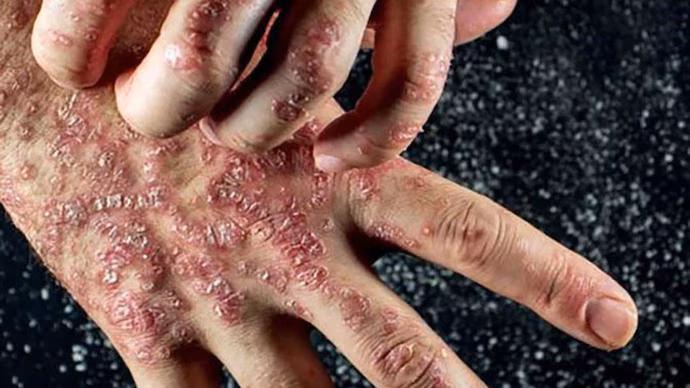 Health autoimmune 0