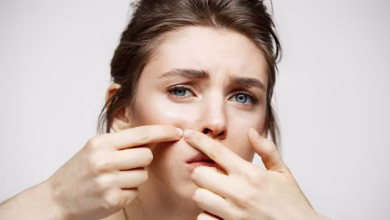 Acne thumb 1200x675 sixteen nine