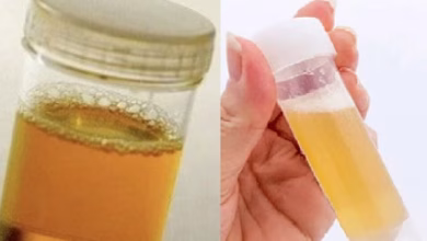 Foamy urine treatment 1693297578
